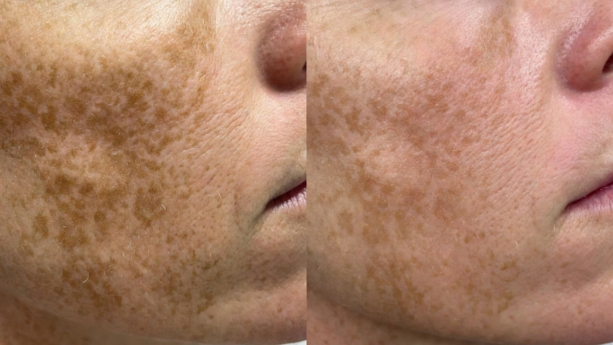 Before and after — dark spots