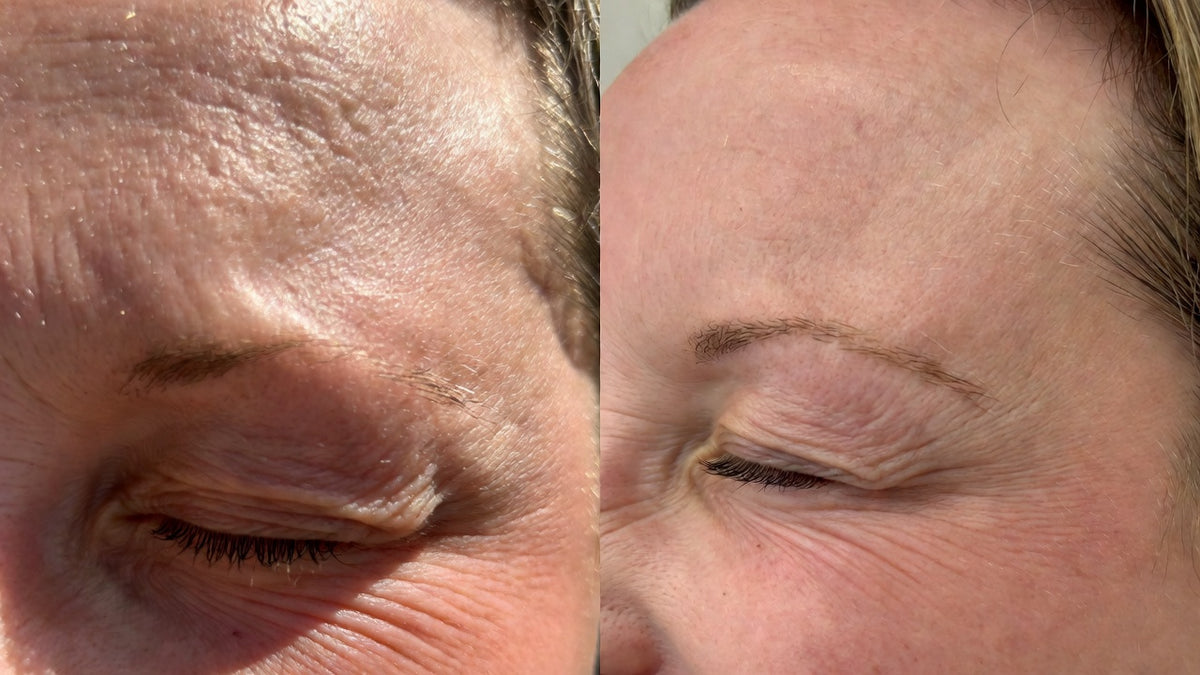Before and after — pores and skin texture
