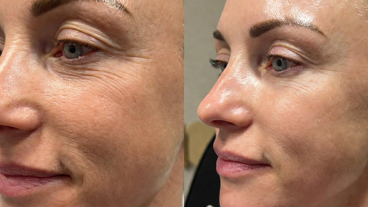 Before and after — fine lines and wrinkles